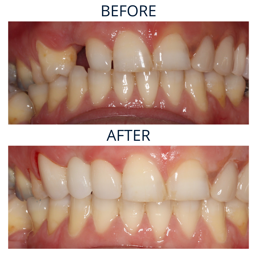 Dental Bridges 1