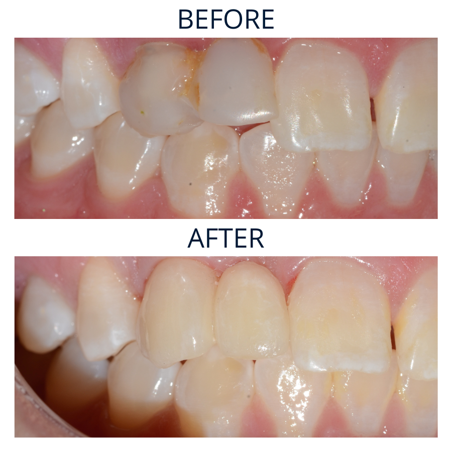 Dental Bridges 3