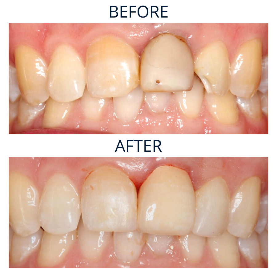 Dental Crowns 1