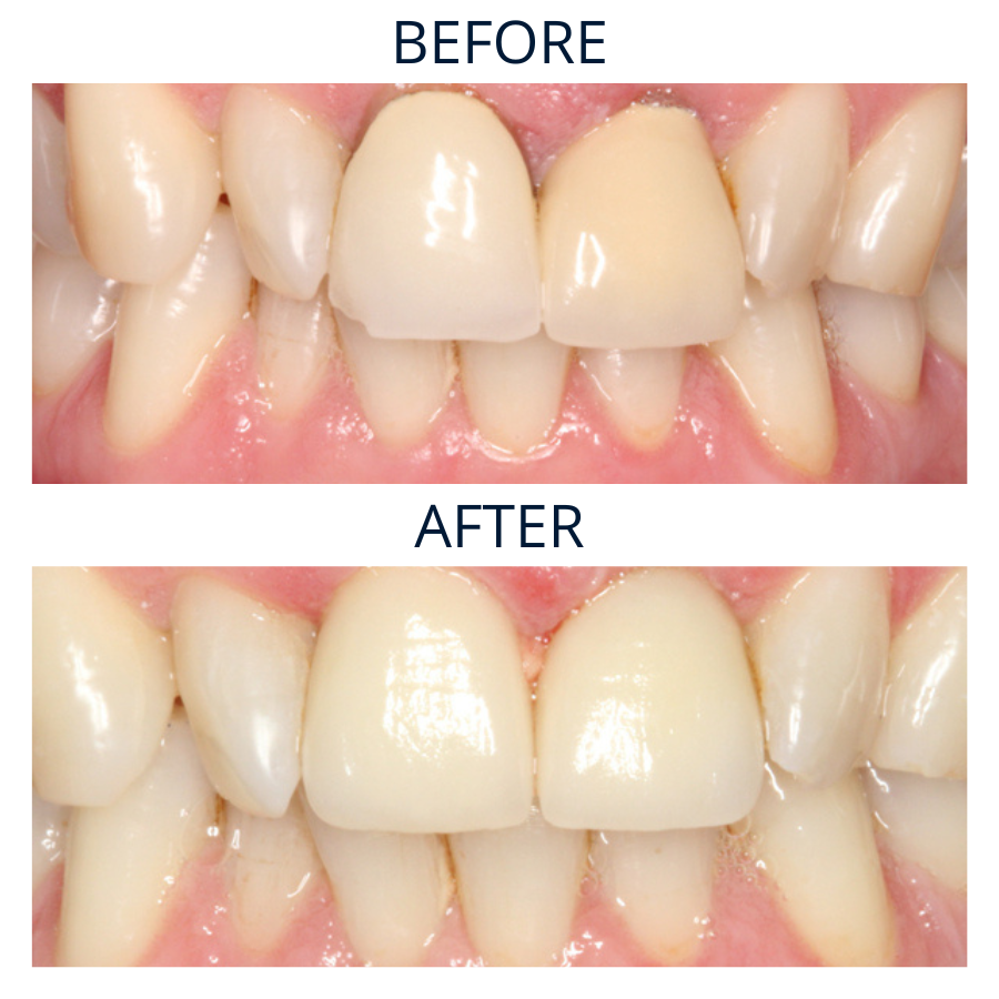 Dental Crowns 3