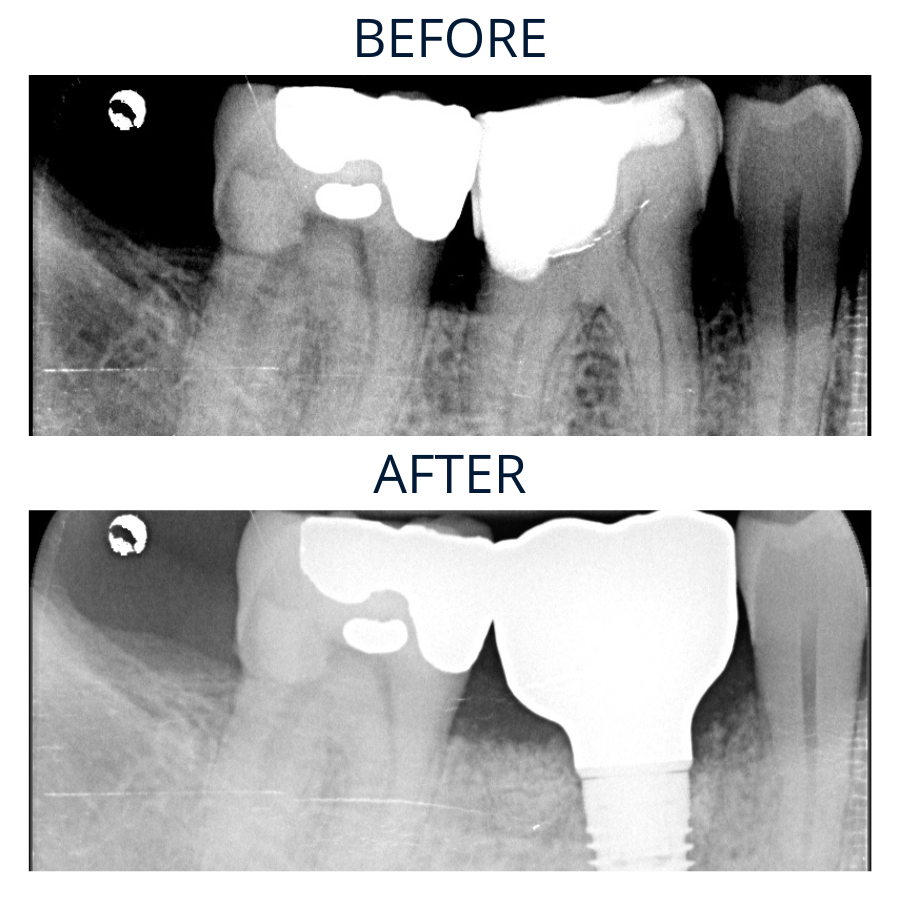 Implant 3