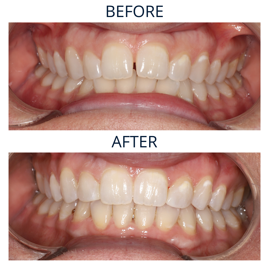 Invisalign 1