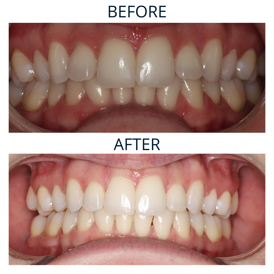 Invisalign 10