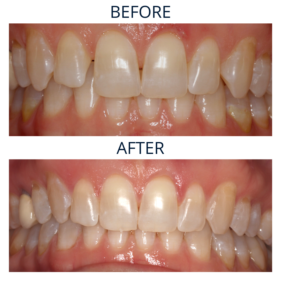 Invisalign 11