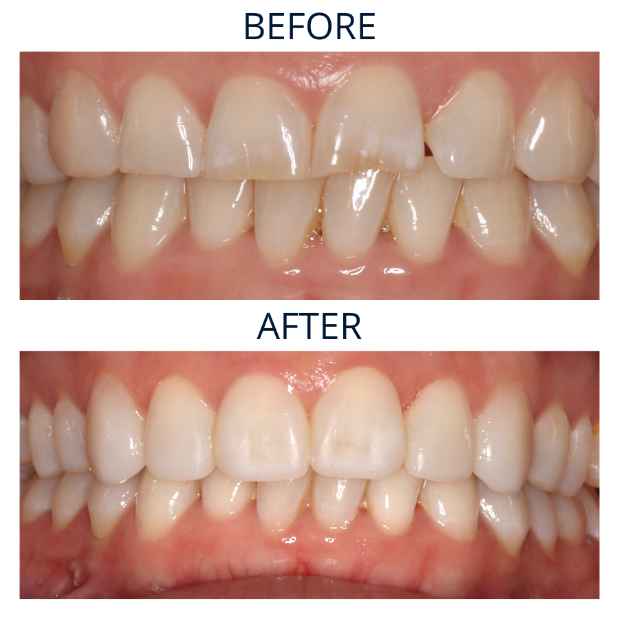 Invisalign 12