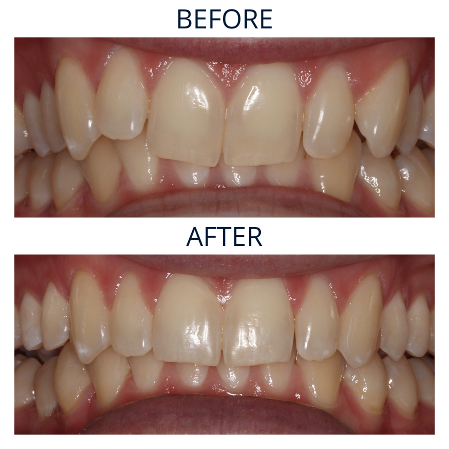 Invisalign 13