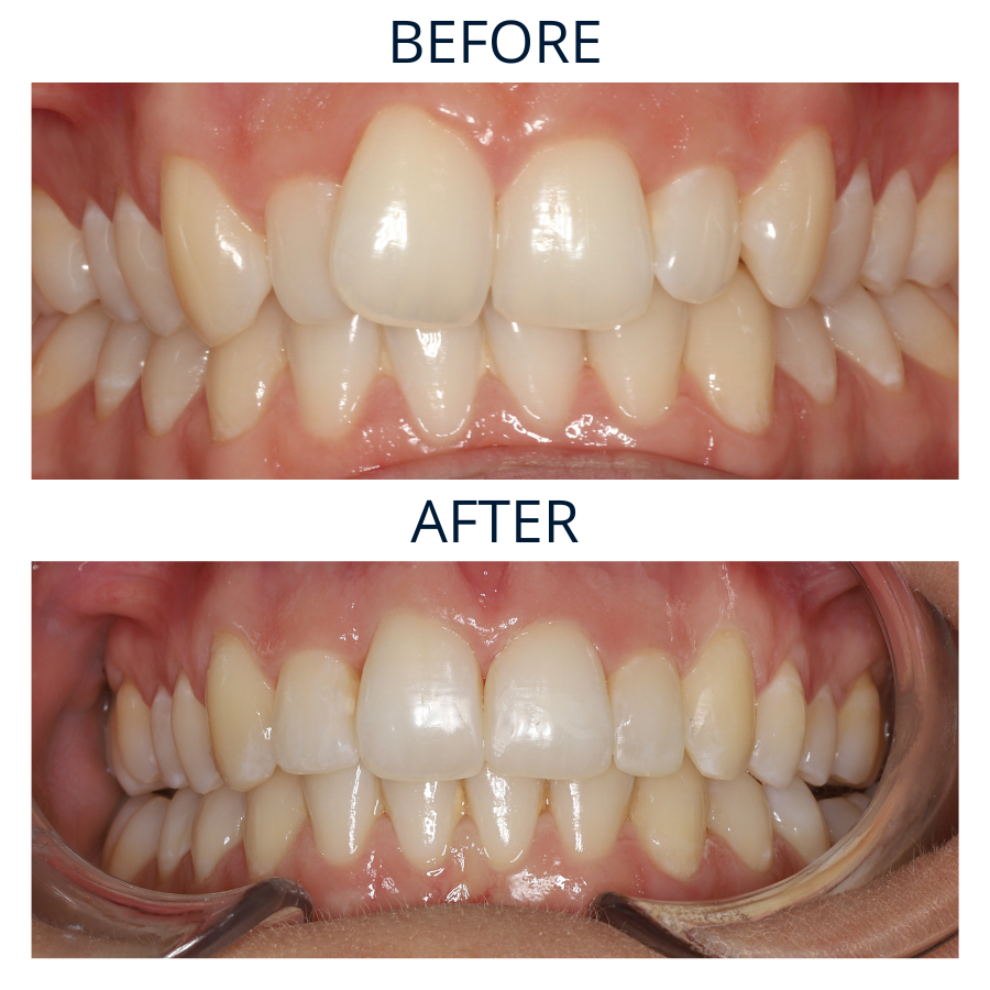 Invisalign 14