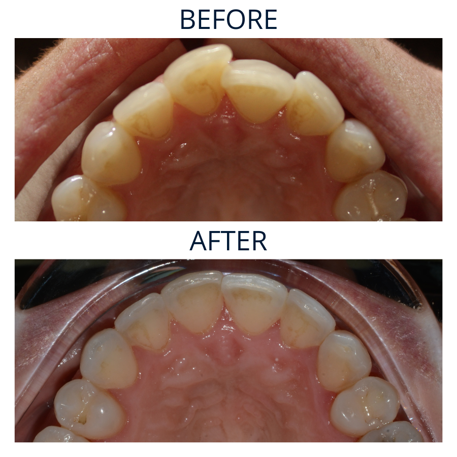 Invisalign 15