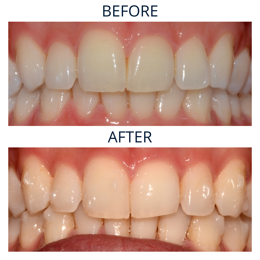 Invisalign 16