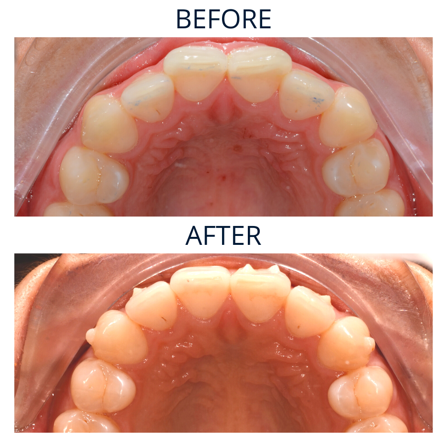 Invisalign 17