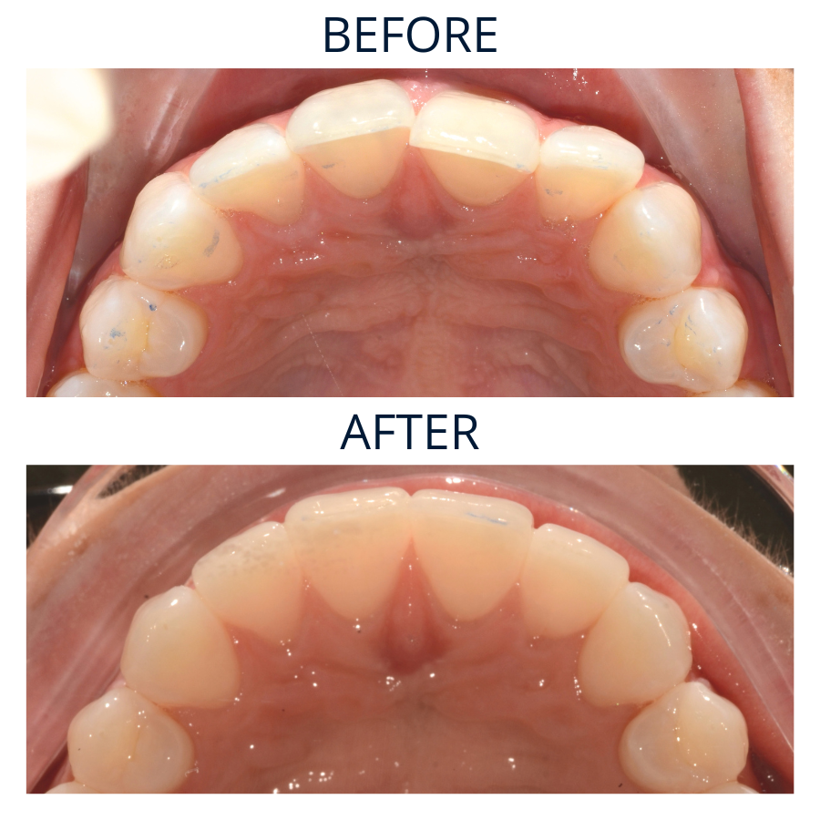 Invisalign 18