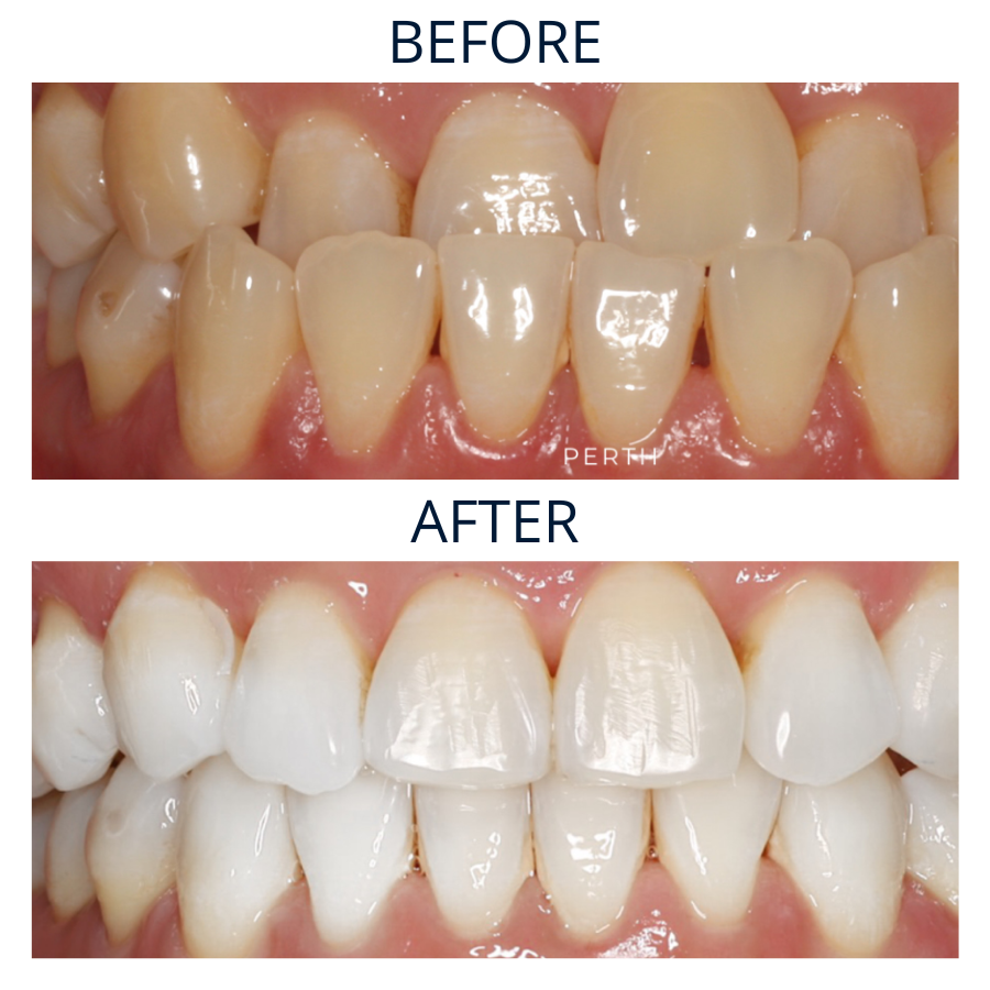 Invisalign 19