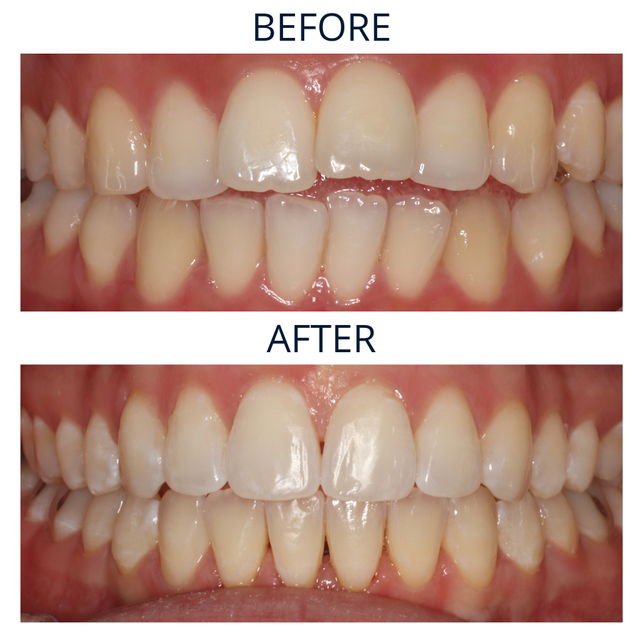 Invisalign 2