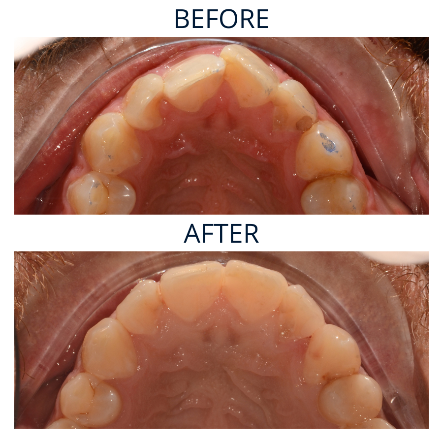 Invisalign 20