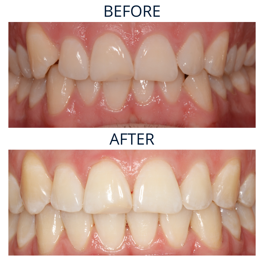 Invisalign 21