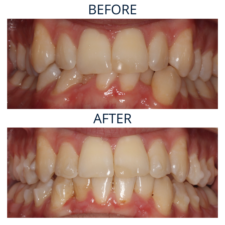 Invisalign 22