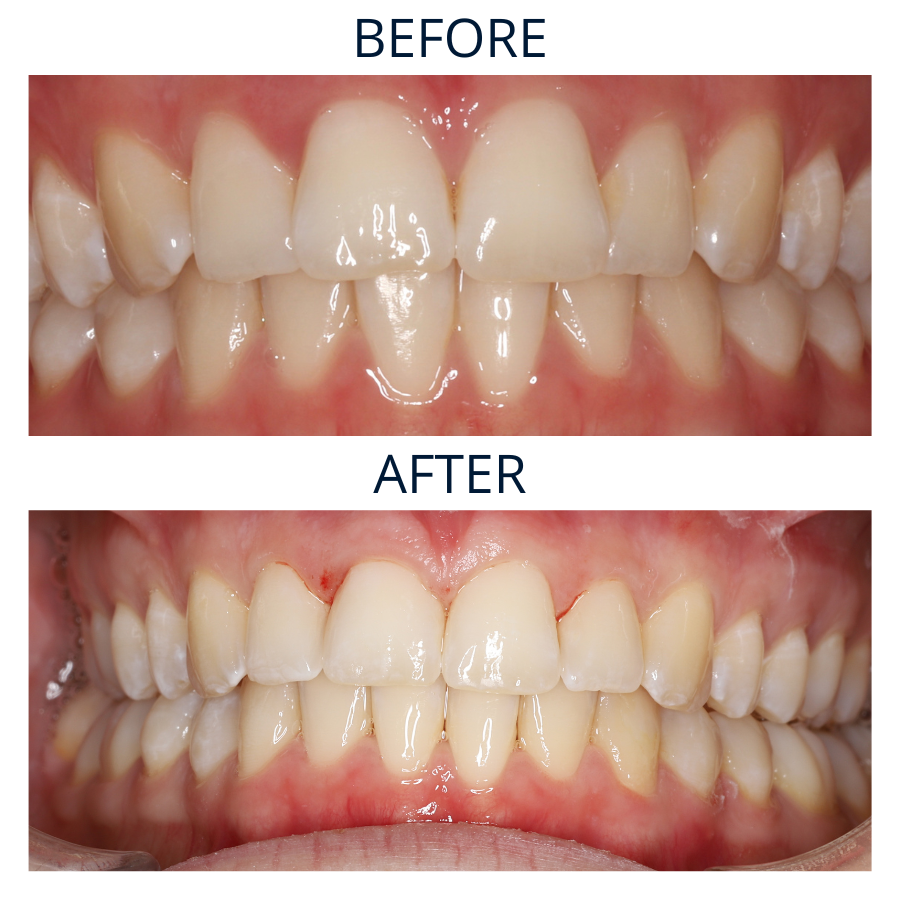 Invisalign 23