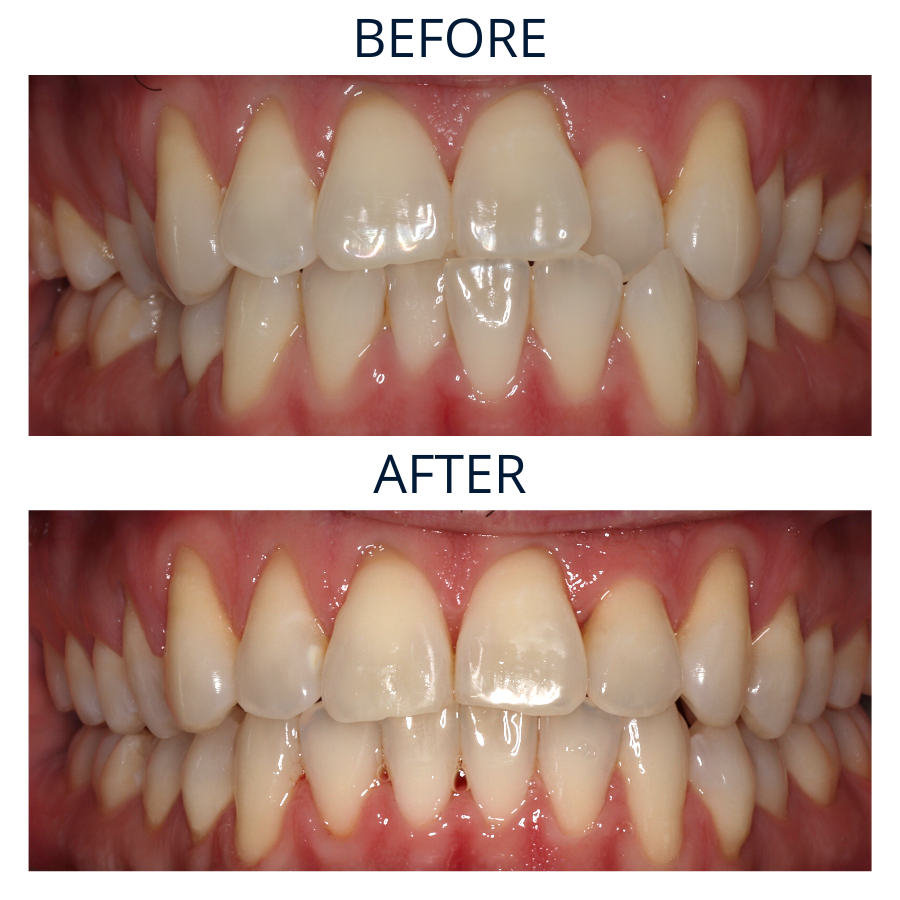 Invisalign 24