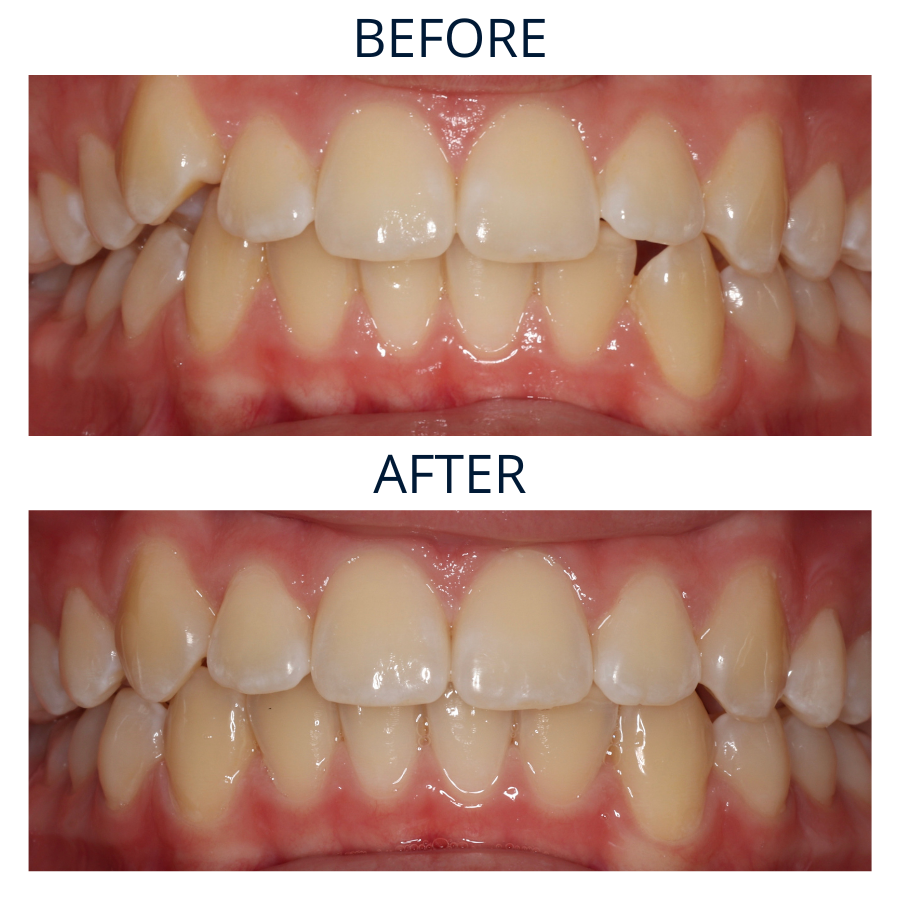 Invisalign 25