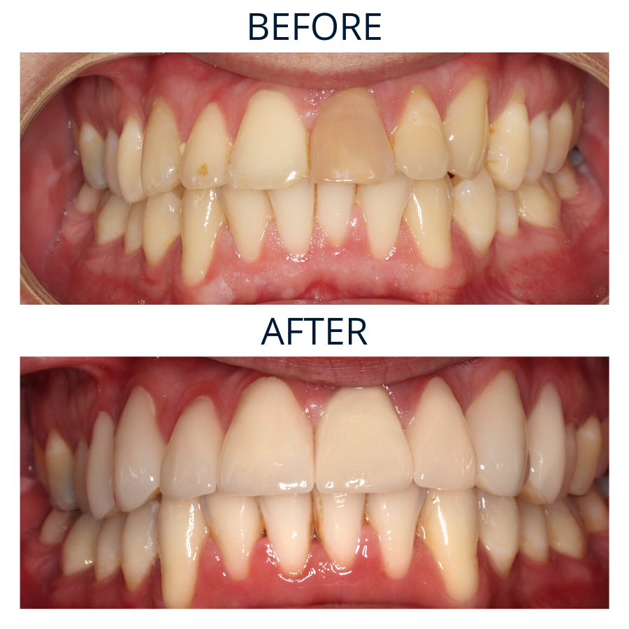 Invisalign 27