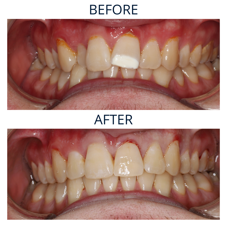 Invisalign 28