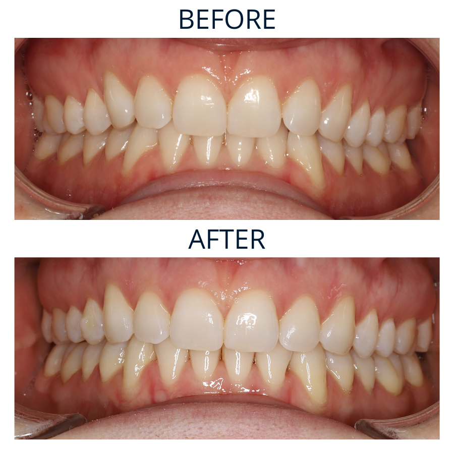 Invisalign 29