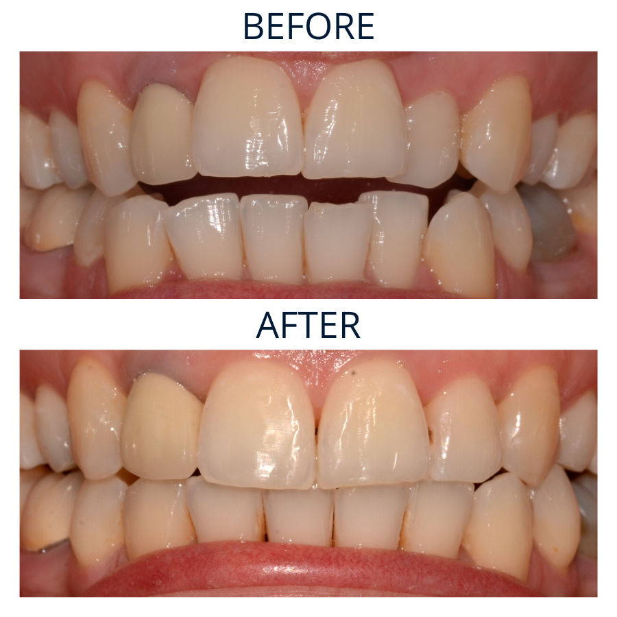 Invisalign 3