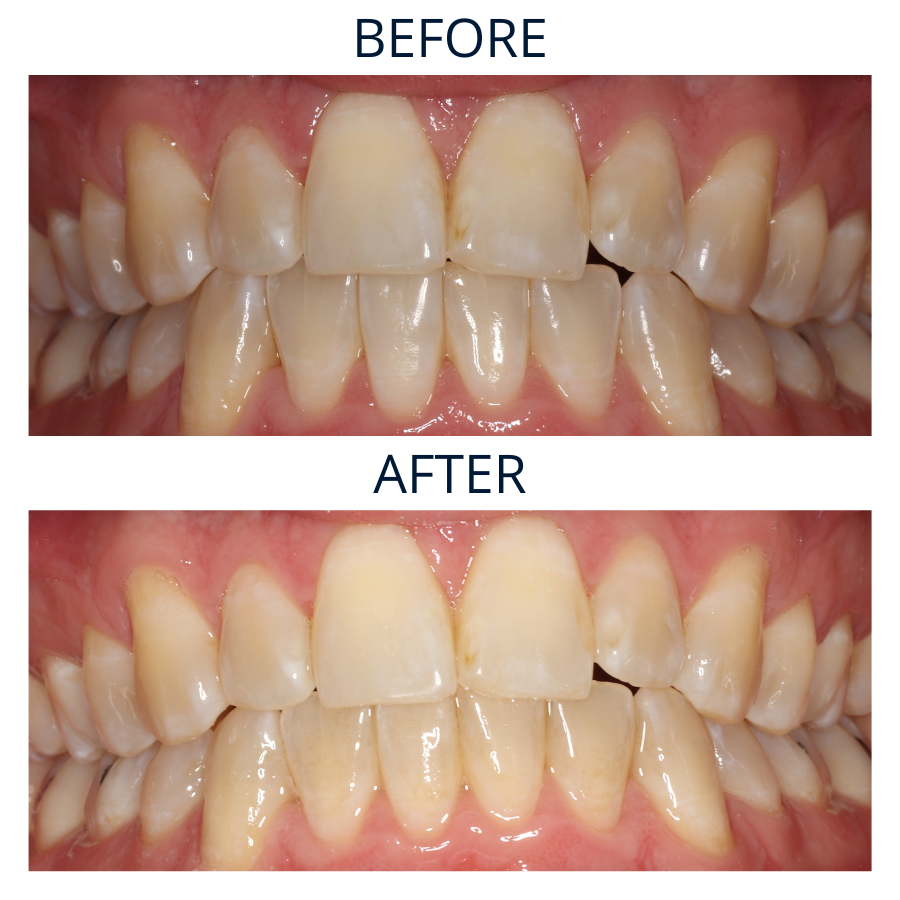 Invisalign 30