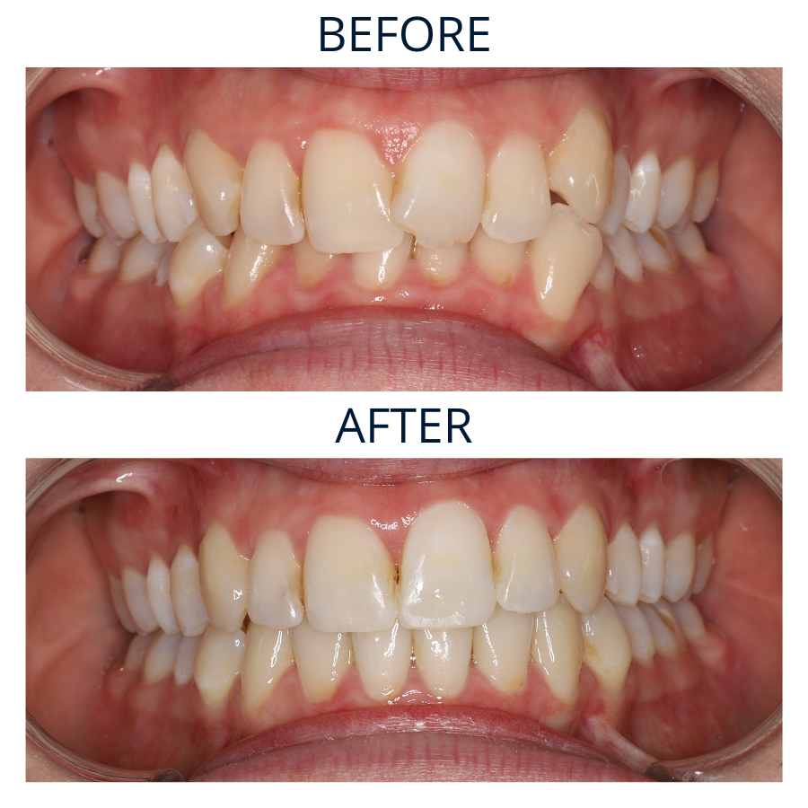 Invisalign 31