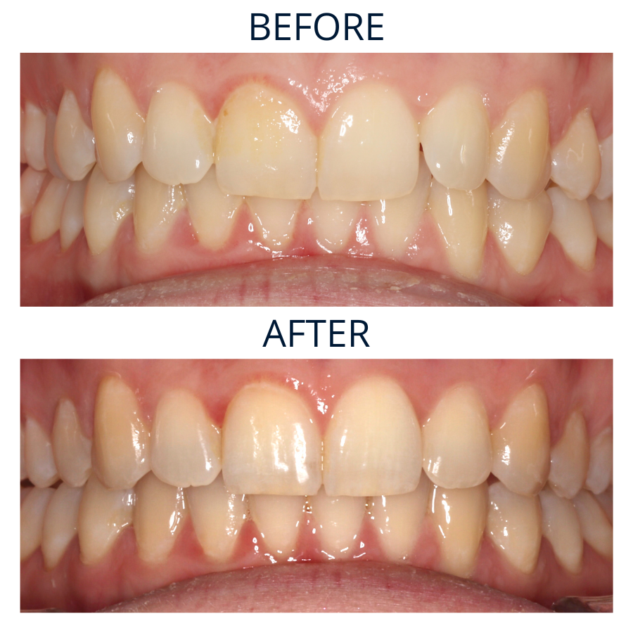 Invisalign 32