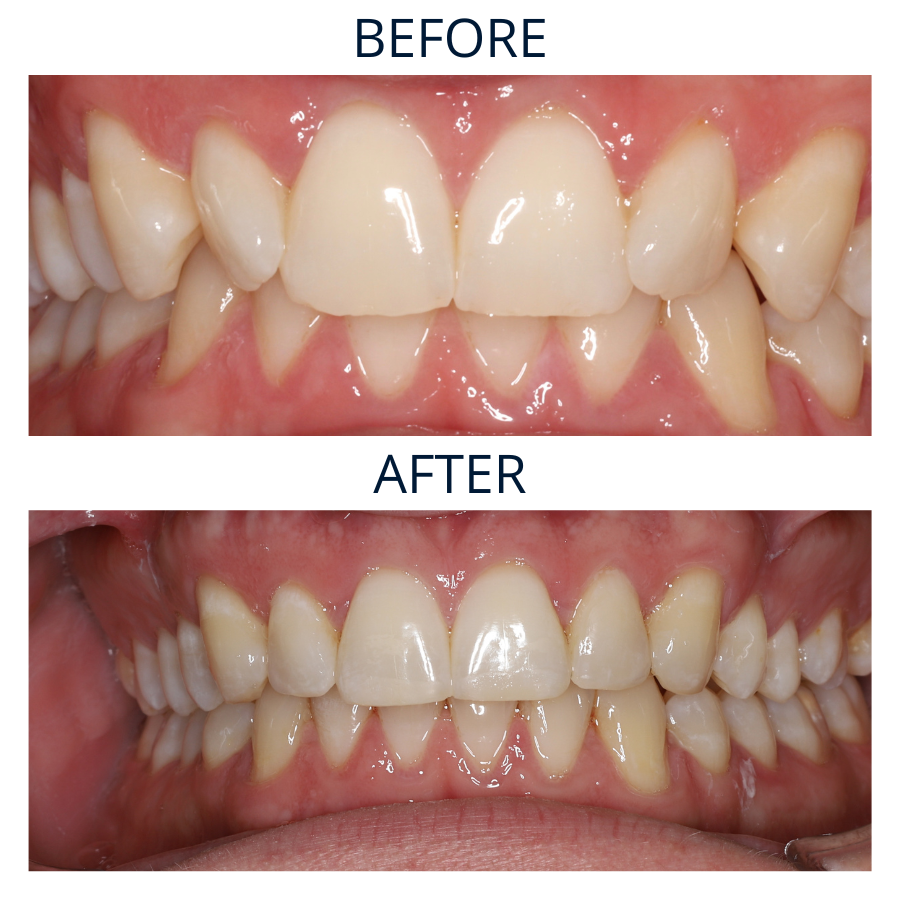 Invisalign 33