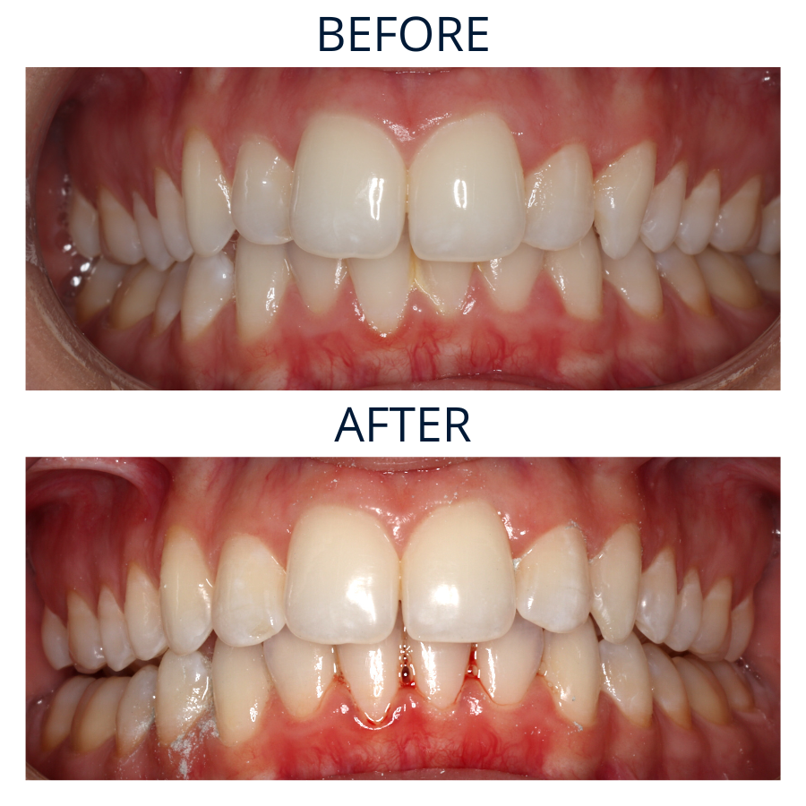 Invisalign 34