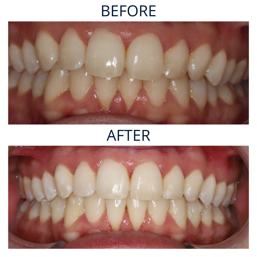 Invisalign 35