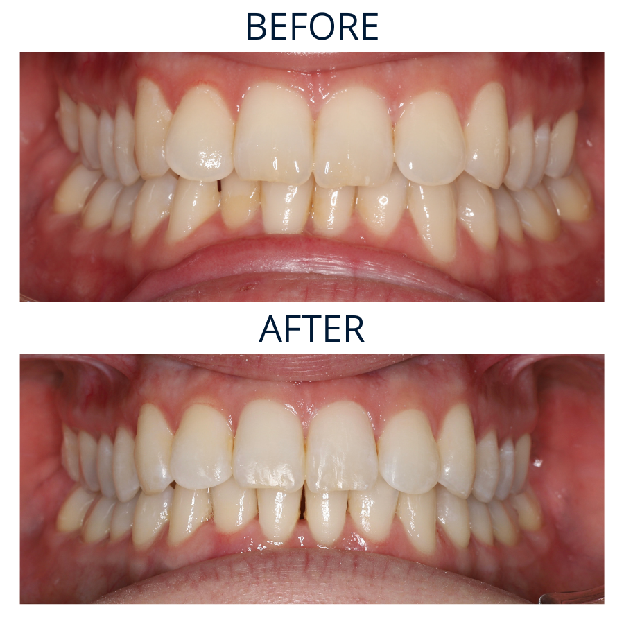 Invisalign 36