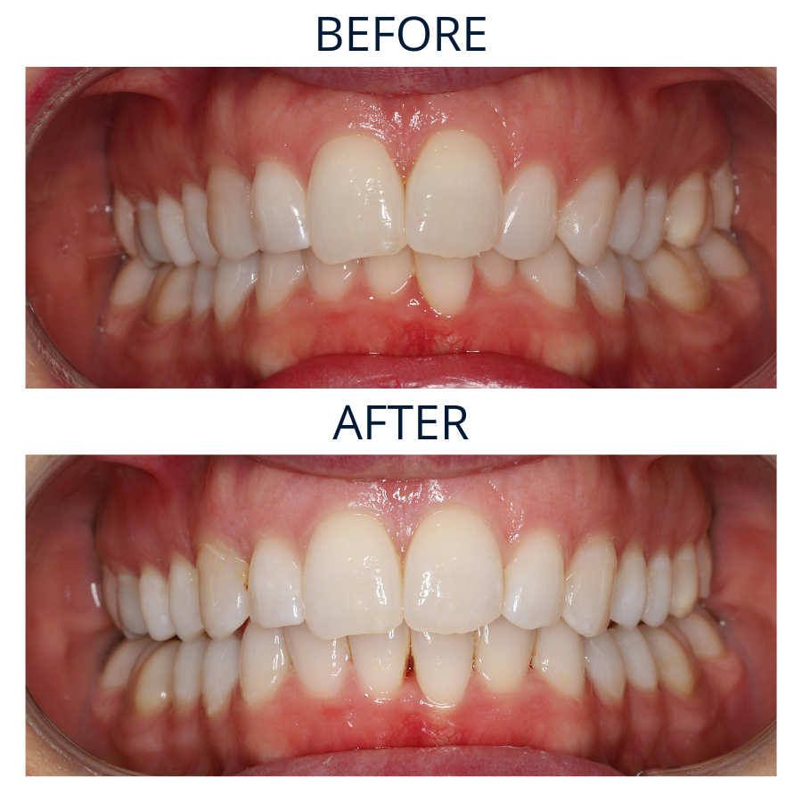 Invisalign 37