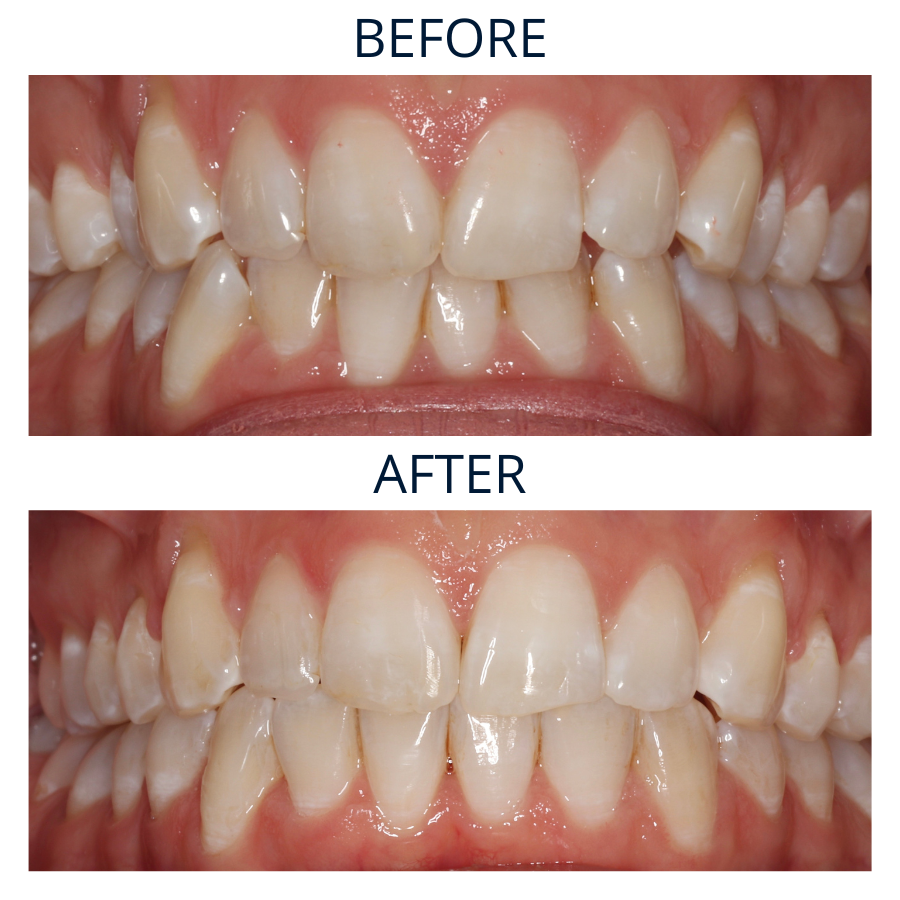 Invisalign 4