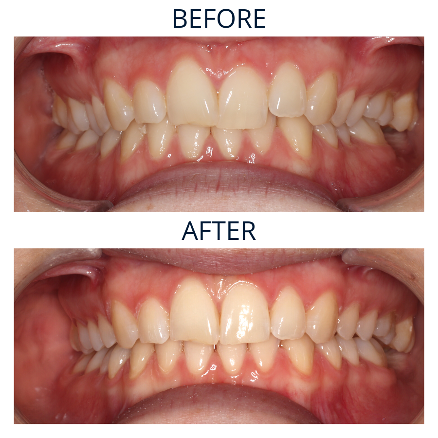 Invisalign 5