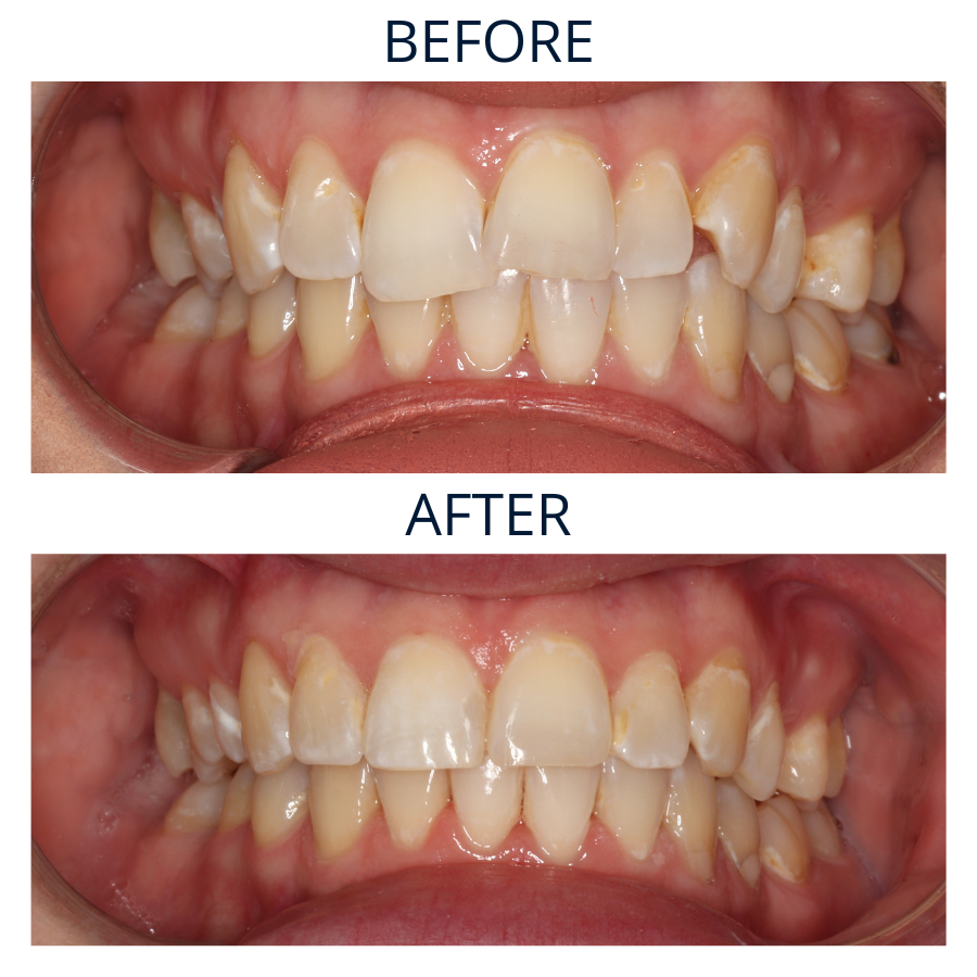 Invisalign 6