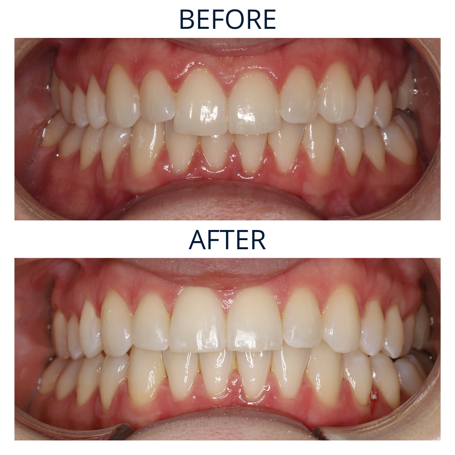 Invisalign 7