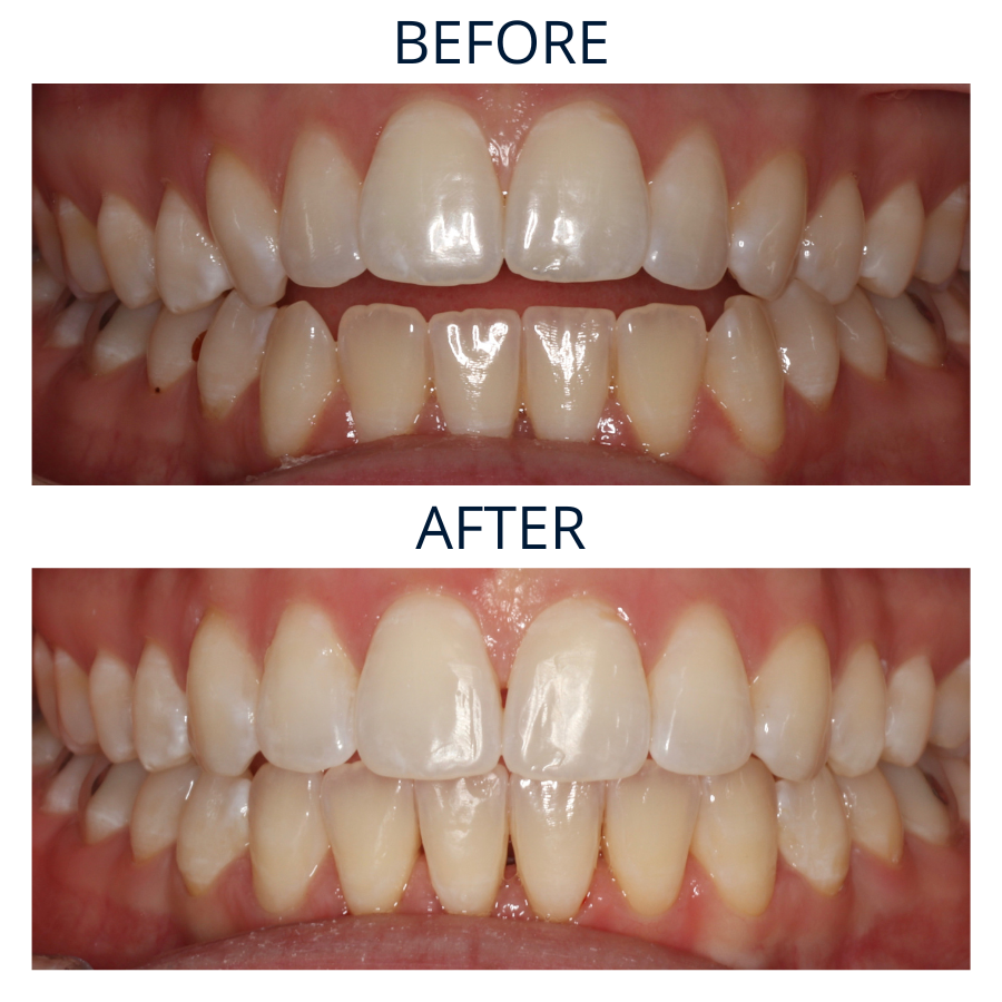 Invisalign 8