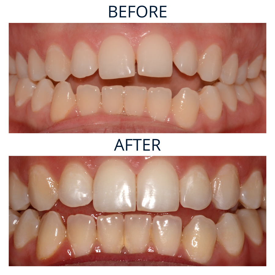 Invisalign 9