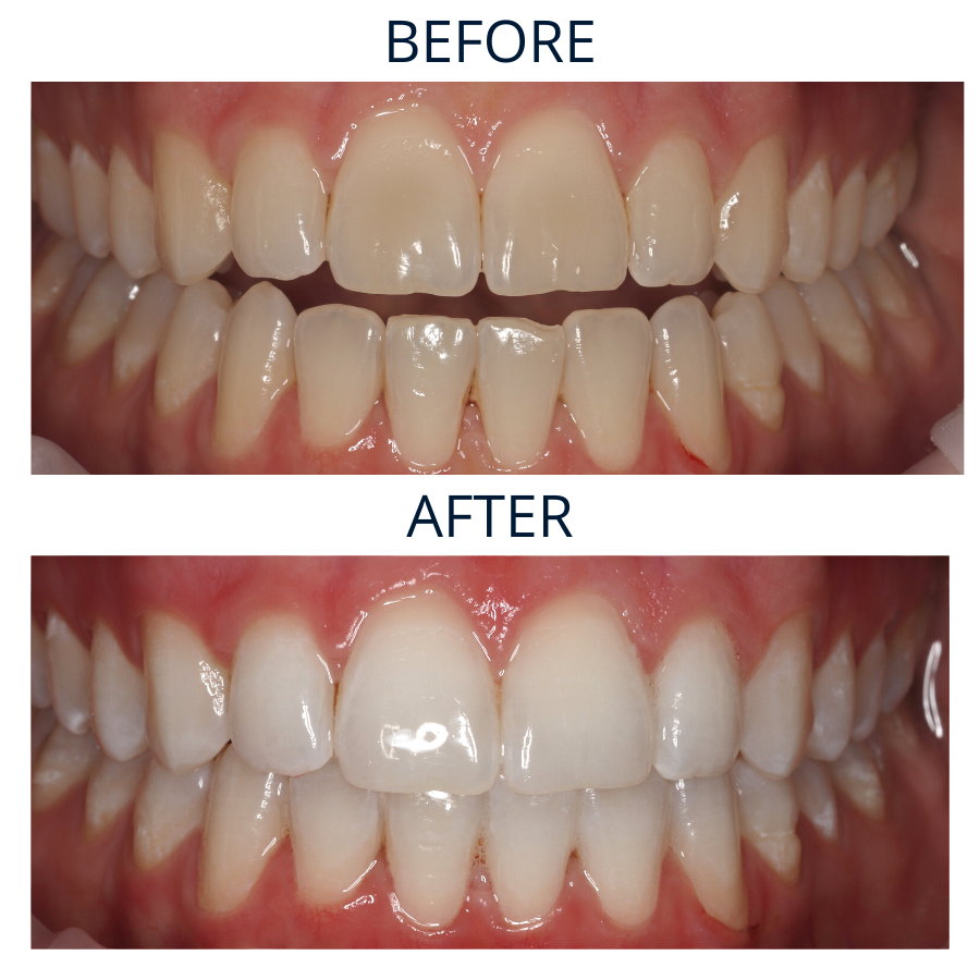 Teeth Whitening 2