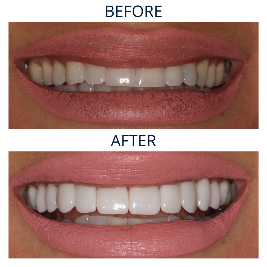 Veneers 25