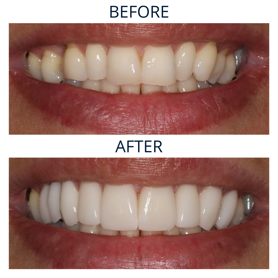 Veneers 28