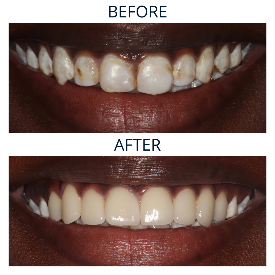 Veneers 30